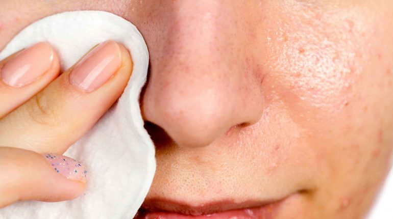 How to get rid of blackheads on nose?