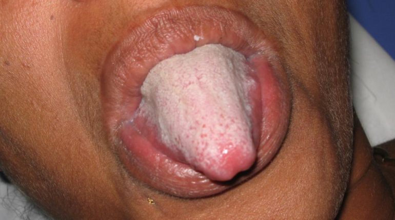 How to get rid of white tongue?