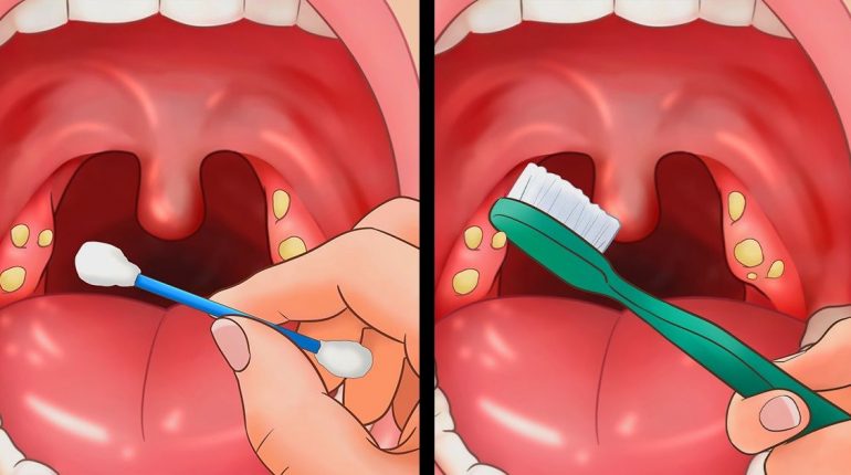 How to get rid of tonsil stones