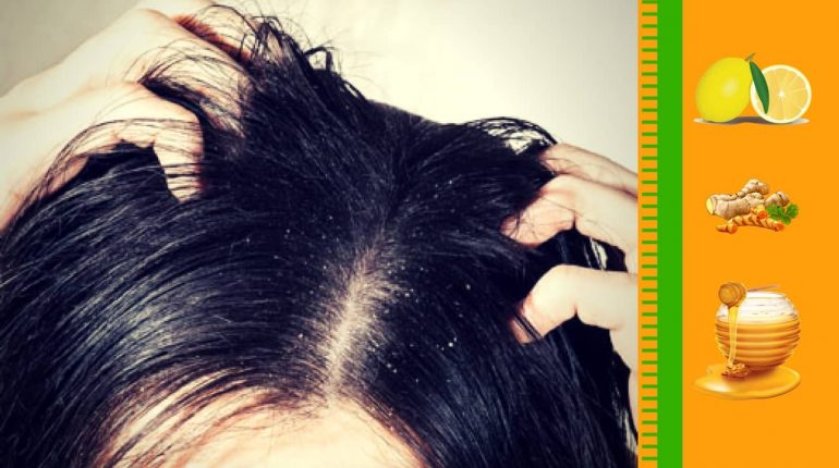 How to remove Dandruff?