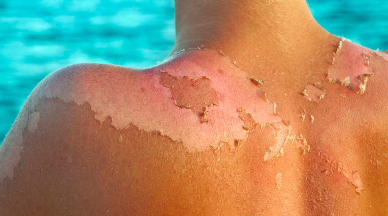 How to get rid of a sunburn fast?